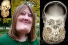 Victoria Wright - cherubism