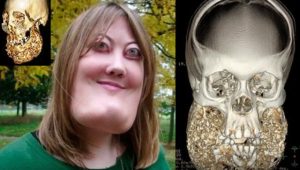 Victoria Wright - cherubism
