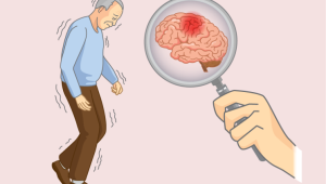 alzheimers