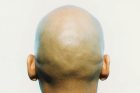 bald head