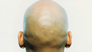 bald head