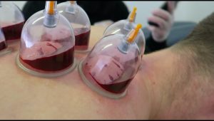 cupping