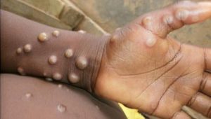 monkeypox